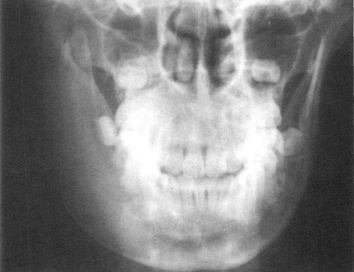 牙骨质瘤x线图片图片